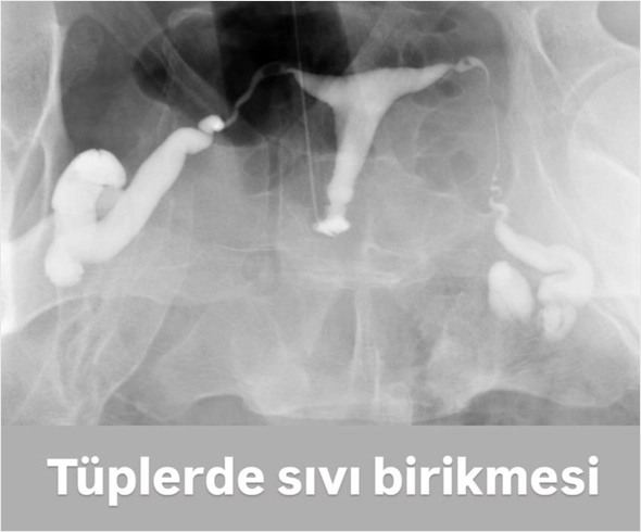 HSG Tüplerde Sıvı Birikmesi