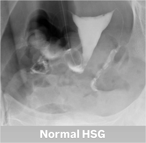 Normal HSG